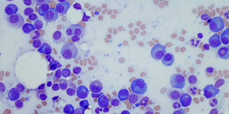 Non sottovalutare il mal di schiena: può essere sintomo di questo raro tumore-okmugello.it