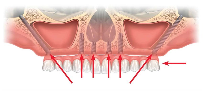 intervista-aldo-iris1